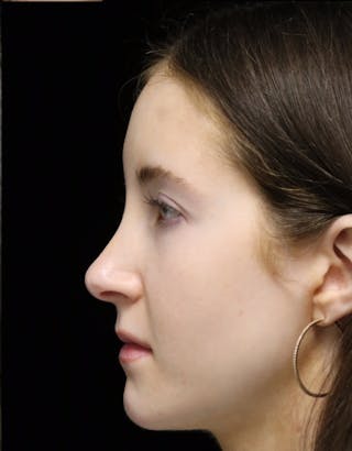Beverly Hills Rhinoplasty Before & After Gallery - Patient 411847 - Image 12 Dr. Deepak Raj Dugar