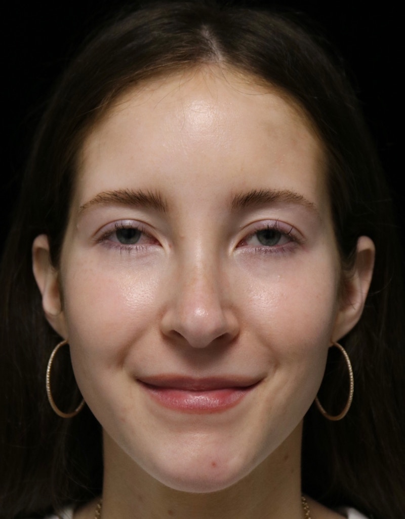 Beverly Hills Rhinoplasty Before & After Gallery - Patient 411847 - Image 8 Dr. Deepak Raj Dugar