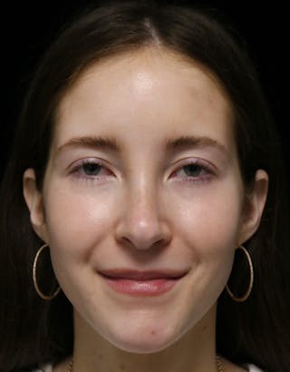 Beverly Hills Rhinoplasty Before & After Gallery - Patient 411847 - Image 8 Dr. Deepak Raj Dugar