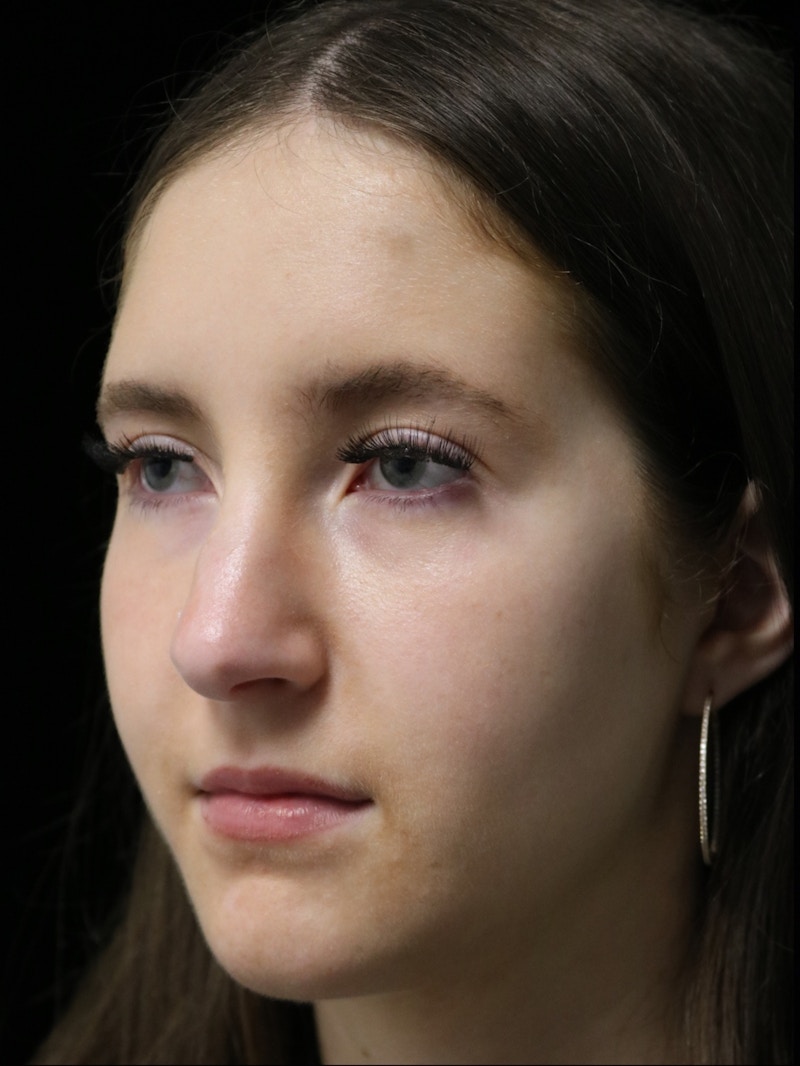 Beverly Hills Rhinoplasty Before & After Gallery - Patient 411847 - Image 9 Dr. Deepak Raj Dugar