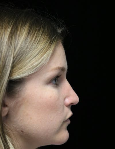 Beverly Hills Rhinoplasty Before & After Gallery - Patient 901684 - Image 2 Dr. Deepak Raj Dugar