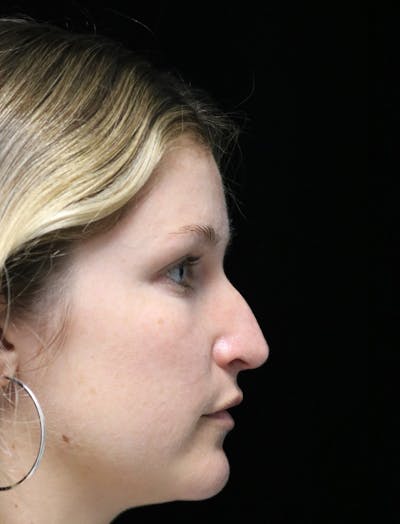 Beverly Hills Rhinoplasty Before & After Gallery - Patient 901684 - Image 1 Dr. Deepak Raj Dugar