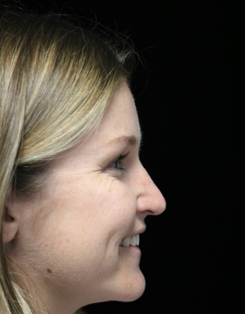 Beverly Hills Rhinoplasty Before & After Gallery - Patient 901684 - Image 4 Dr. Deepak Raj Dugar