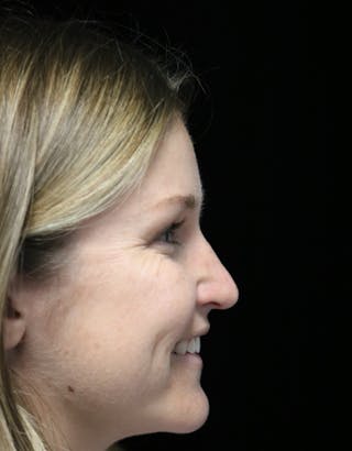 Beverly Hills Rhinoplasty Before & After Gallery - Patient 901684 - Image 4 Dr. Deepak Raj Dugar