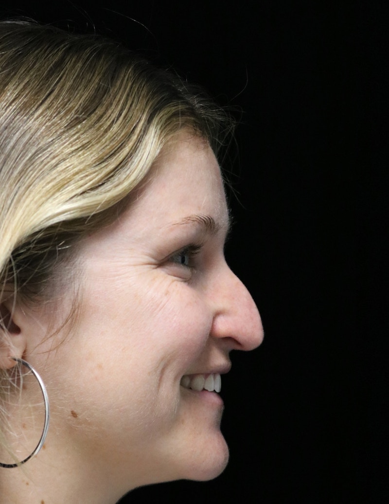 Beverly Hills Rhinoplasty Before & After Gallery - Patient 901684 - Image 3 Dr. Deepak Raj Dugar