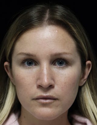 Beverly Hills Rhinoplasty Before & After Gallery - Patient 901684 - Image 6 Dr. Deepak Raj Dugar