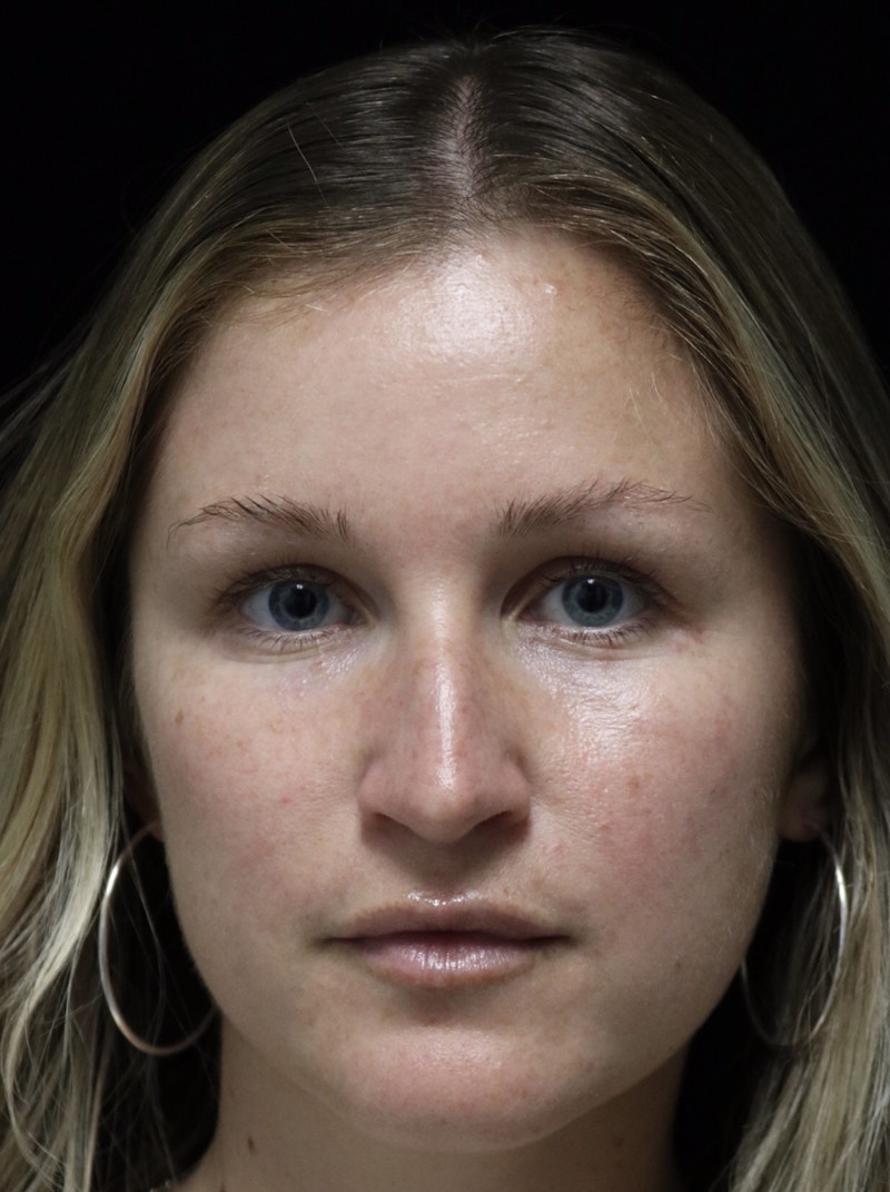 Beverly Hills Rhinoplasty Before & After Gallery - Patient 901684 - Image 5 Dr. Deepak Raj Dugar