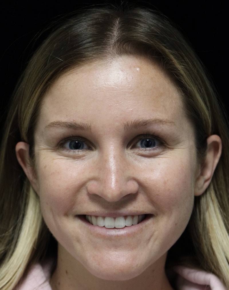 Beverly Hills Rhinoplasty Before & After Gallery - Patient 901684 - Image 8 Dr. Deepak Raj Dugar