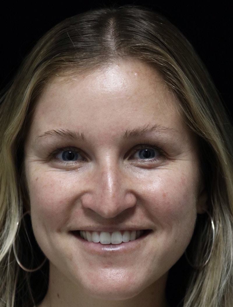 Beverly Hills Rhinoplasty Before & After Gallery - Patient 901684 - Image 7 Dr. Deepak Raj Dugar