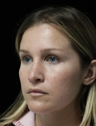 Beverly Hills Rhinoplasty Before & After Gallery - Patient 901684 - Image 10 Dr. Deepak Raj Dugar