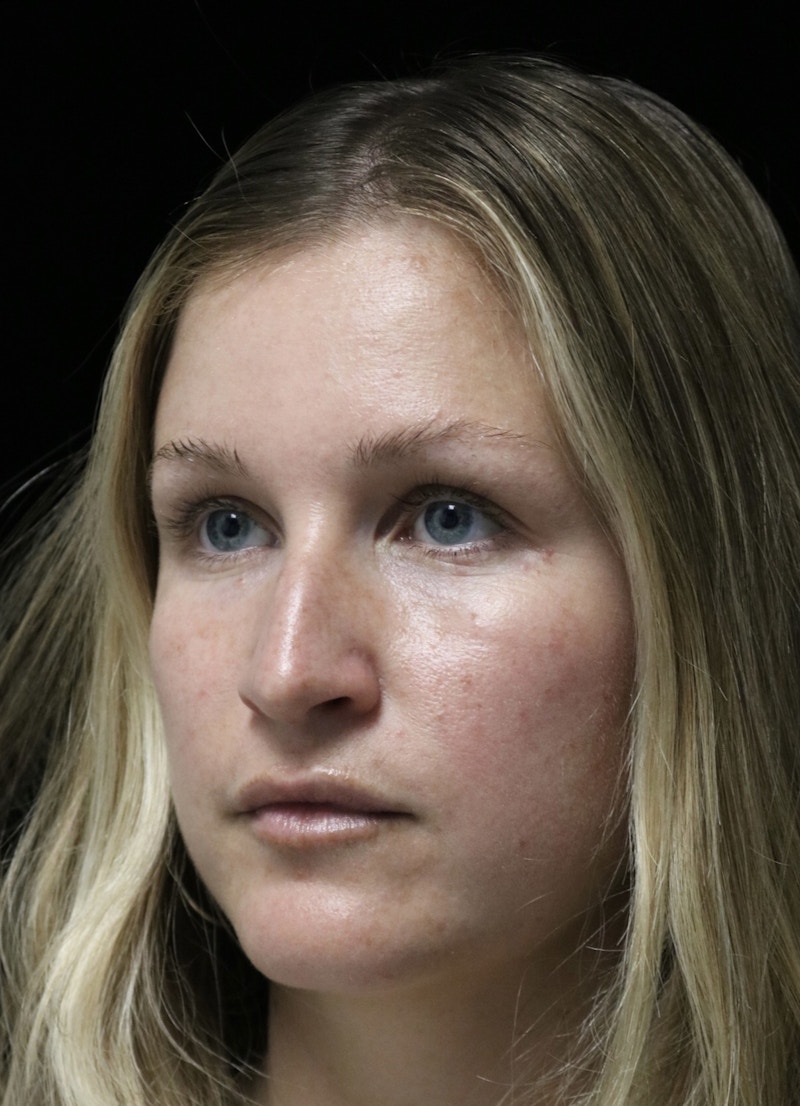 Beverly Hills Rhinoplasty Before & After Gallery - Patient 901684 - Image 9 Dr. Deepak Raj Dugar