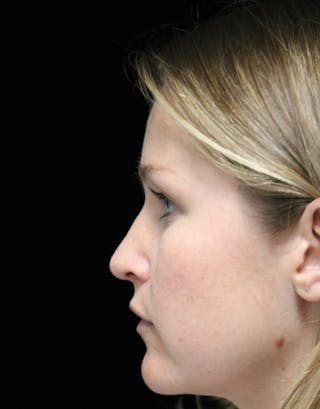 Beverly Hills Rhinoplasty Before & After Gallery - Patient 901684 - Image 12 Dr. Deepak Raj Dugar