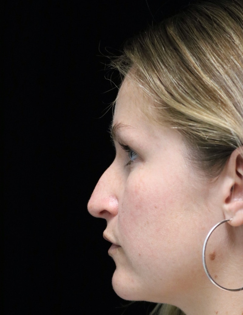 Beverly Hills Rhinoplasty Before & After Gallery - Patient 901684 - Image 11 Dr. Deepak Raj Dugar