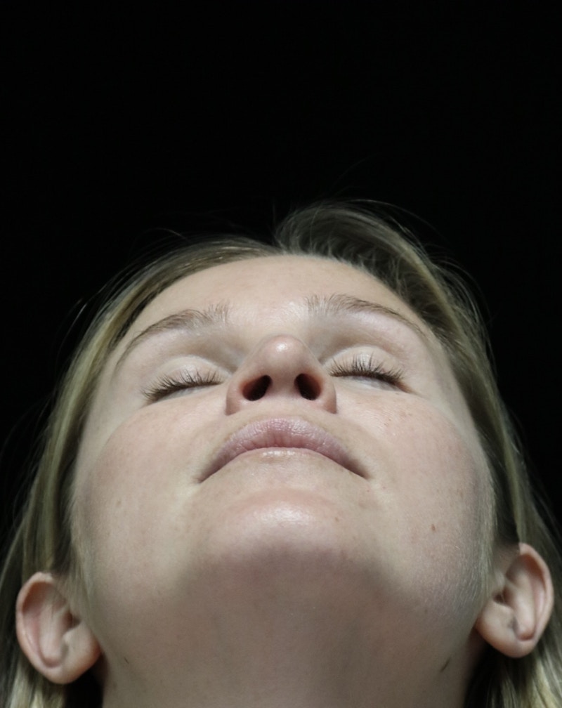 Beverly Hills Rhinoplasty Before & After Gallery - Patient 901684 - Image 14 Dr. Deepak Raj Dugar