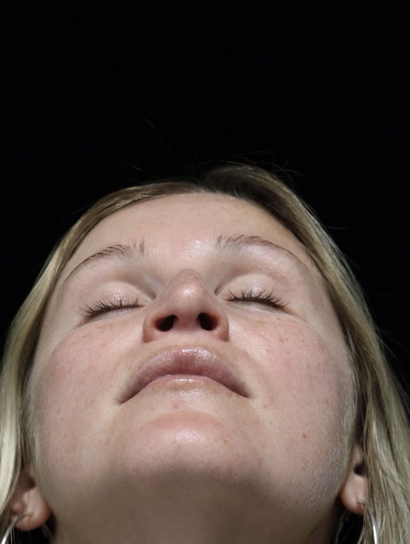 Beverly Hills Rhinoplasty Before & After Gallery - Patient 901684 - Image 13 Dr. Deepak Raj Dugar