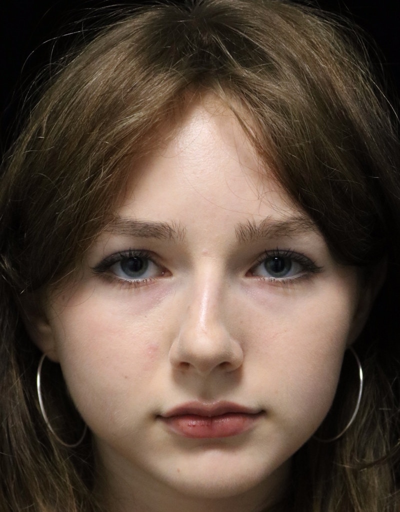 Beverly Hills Rhinoplasty Before & After Gallery - Patient 137700 - Image 5 Dr. Deepak Raj Dugar