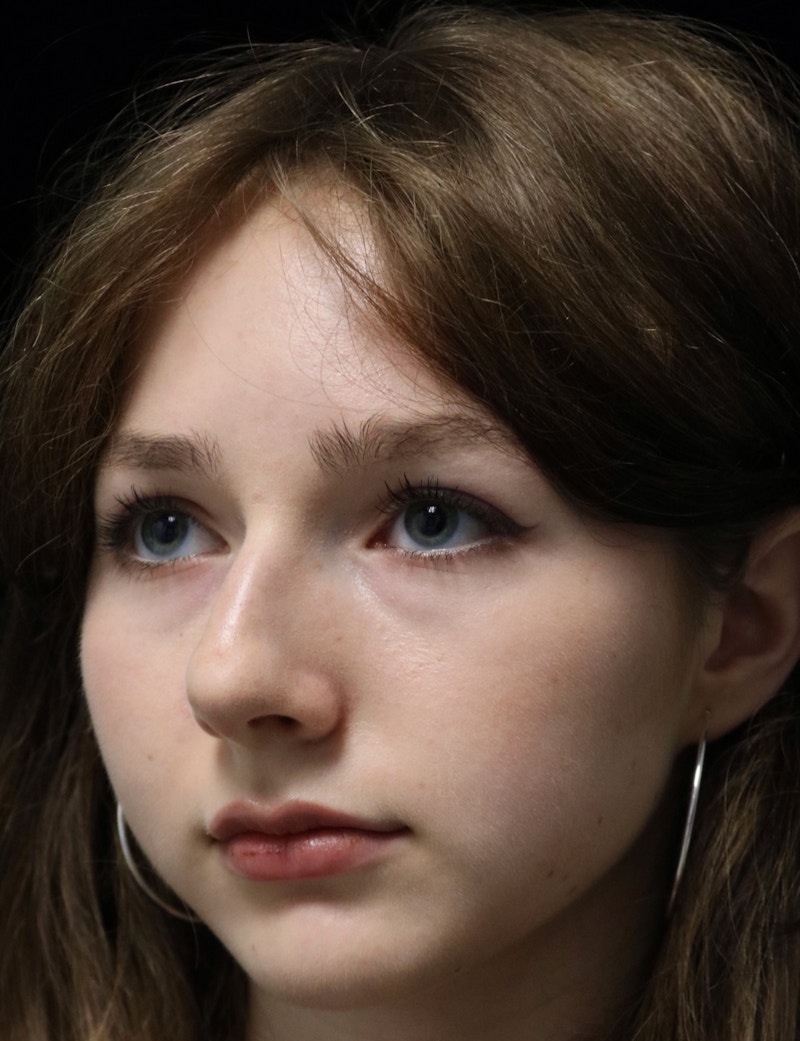 Beverly Hills Rhinoplasty Before & After Gallery - Patient 137700 - Image 9 Dr. Deepak Raj Dugar