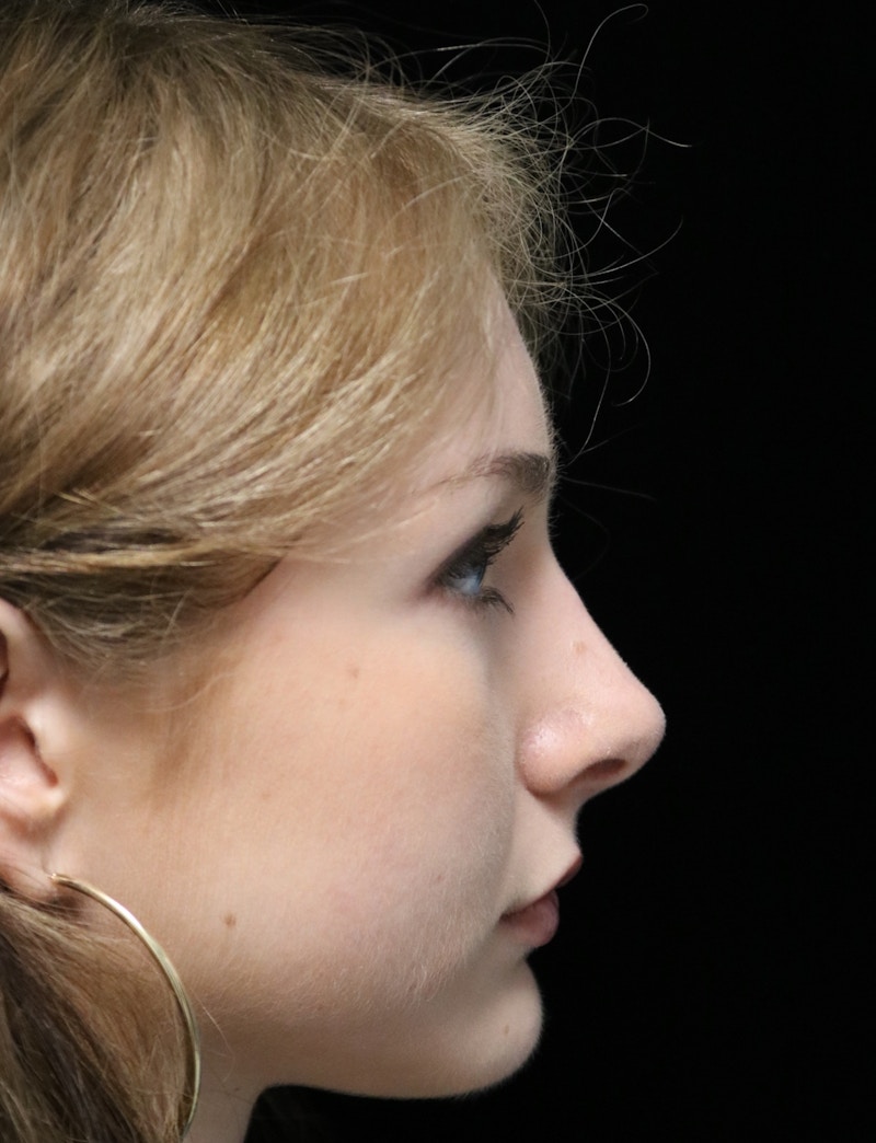 Beverly Hills Rhinoplasty Before & After Gallery - Patient 137700 - Image 2 Dr. Deepak Raj Dugar