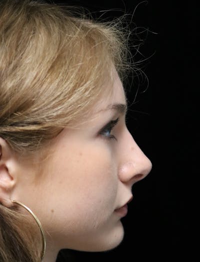 Beverly Hills Rhinoplasty Before & After Gallery - Patient 137700 - Image 2 Dr. Deepak Raj Dugar