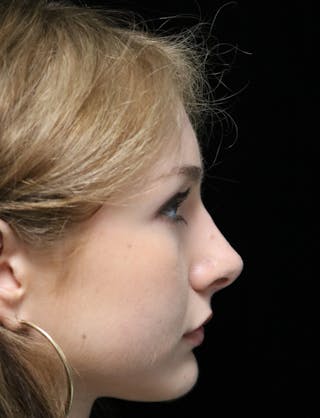 Beverly Hills Rhinoplasty Before & After Gallery - Patient 137700 - Image 2 Dr. Deepak Raj Dugar