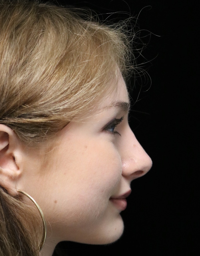 Beverly Hills Rhinoplasty Before & After Gallery - Patient 137700 - Image 4 Dr. Deepak Raj Dugar