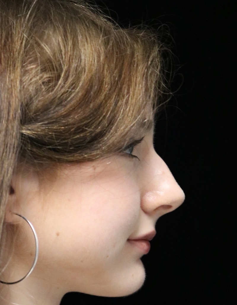 Beverly Hills Rhinoplasty Before & After Gallery - Patient 137700 - Image 3 Dr. Deepak Raj Dugar