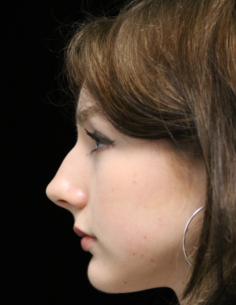 Beverly Hills Rhinoplasty Before & After Gallery - Patient 137700 - Image 11 Dr. Deepak Raj Dugar