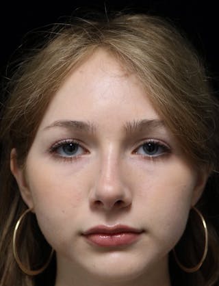 Beverly Hills Rhinoplasty Before & After Gallery - Patient 137700 - Image 6 Dr. Deepak Raj Dugar