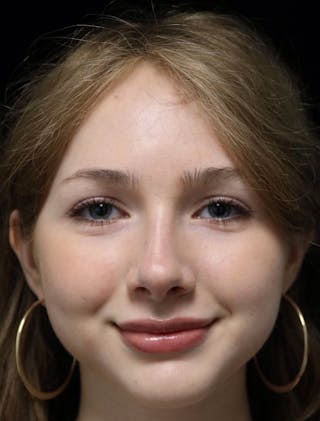 Beverly Hills Rhinoplasty Before & After Gallery - Patient 137700 - Image 8 Dr. Deepak Raj Dugar