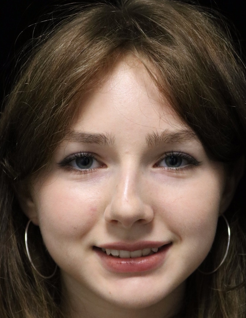 Beverly Hills Rhinoplasty Before & After Gallery - Patient 137700 - Image 7 Dr. Deepak Raj Dugar