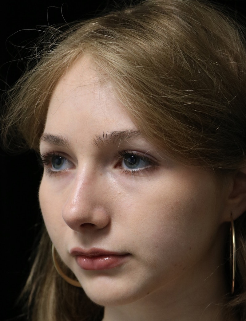 Beverly Hills Rhinoplasty Before & After Gallery - Patient 137700 - Image 10 Dr. Deepak Raj Dugar