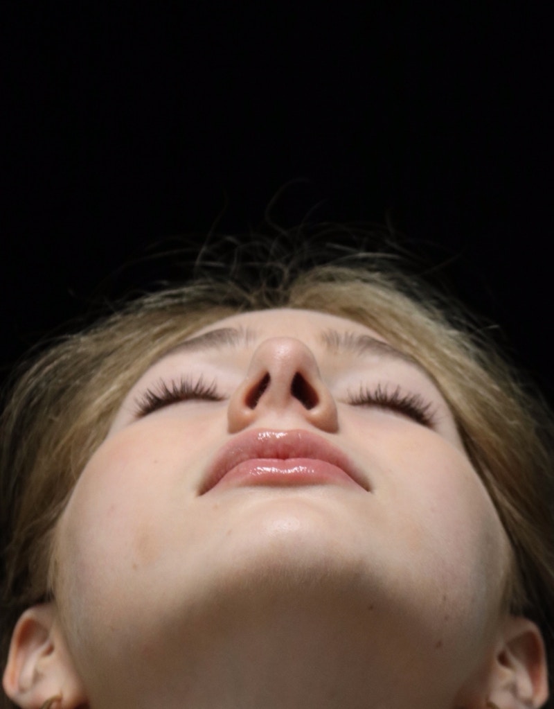 Beverly Hills Rhinoplasty Before & After Gallery - Patient 137700 - Image 14 Dr. Deepak Raj Dugar