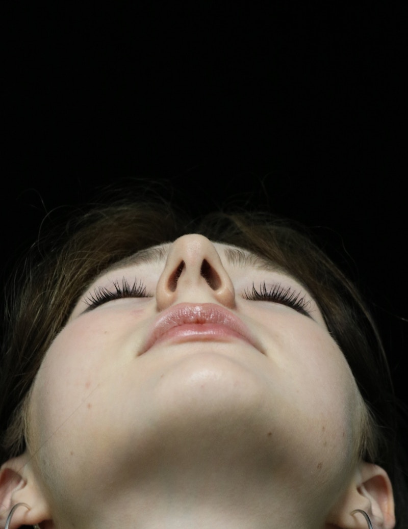 Beverly Hills Rhinoplasty Before & After Gallery - Patient 137700 - Image 13 Dr. Deepak Raj Dugar