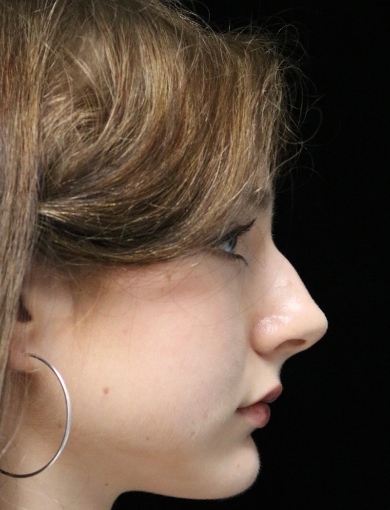 Beverly Hills Rhinoplasty Before & After Gallery - Patient 137700 - Image 1 Dr. Deepak Raj Dugar