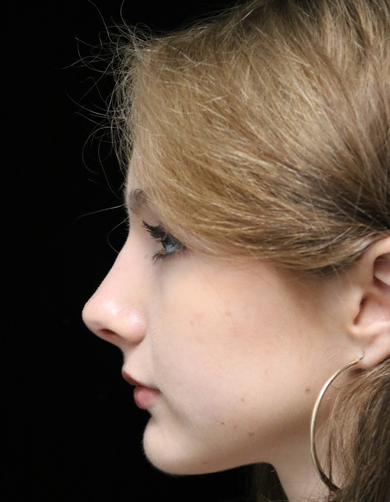 Beverly Hills Rhinoplasty Before & After Gallery - Patient 137700 - Image 12 Dr. Deepak Raj Dugar