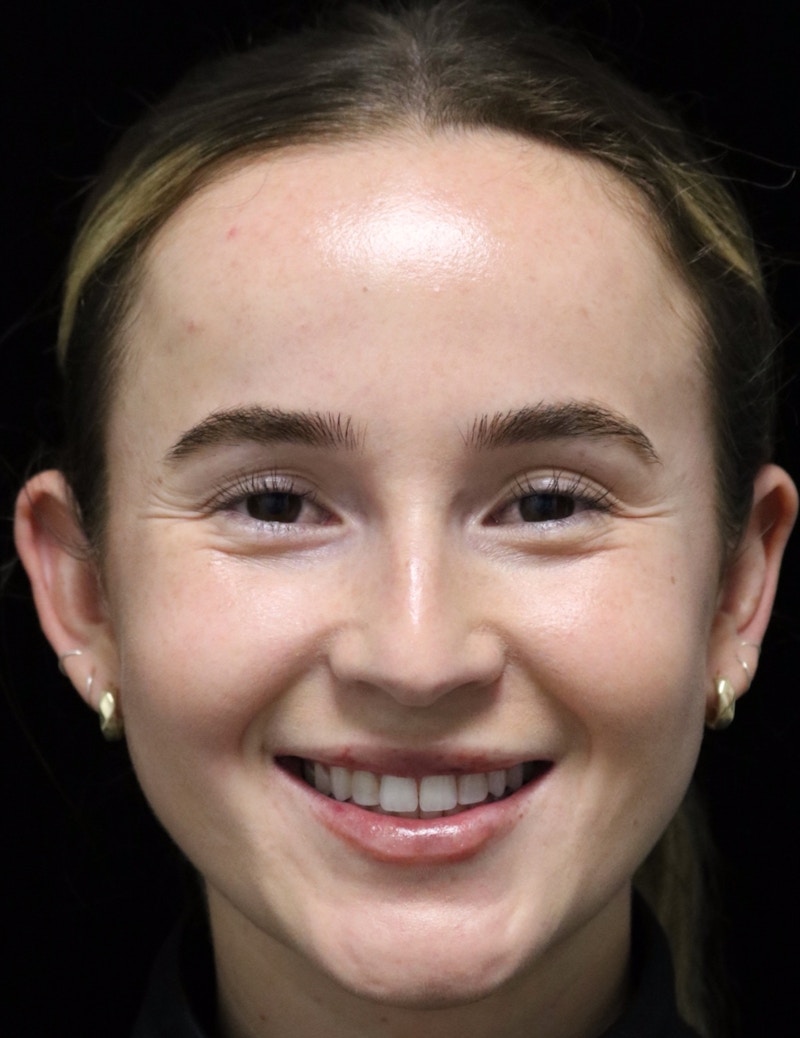 Beverly Hills Rhinoplasty Before & After Gallery - Patient 264675 - Image 7 Dr. Deepak Raj Dugar