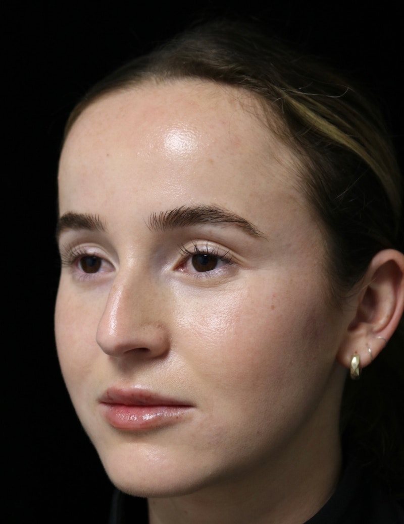 Beverly Hills Rhinoplasty Before & After Gallery - Patient 264675 - Image 9 Dr. Deepak Raj Dugar