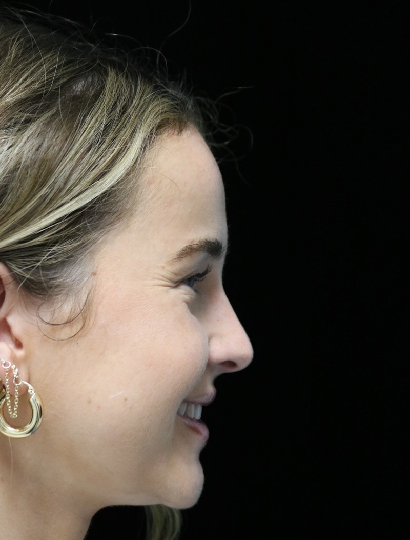 Beverly Hills Rhinoplasty Before & After Gallery - Patient 264675 - Image 4 Dr. Deepak Raj Dugar