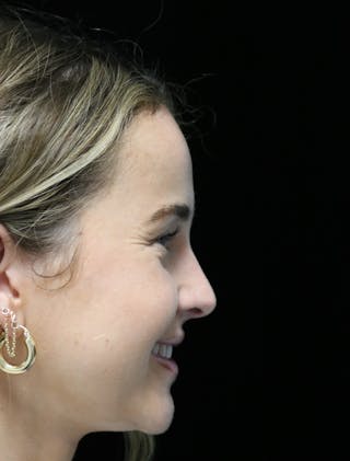 Beverly Hills Rhinoplasty Before & After Gallery - Patient 264675 - Image 4 Dr. Deepak Raj Dugar