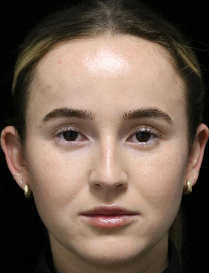 Beverly Hills Rhinoplasty Before & After Gallery - Patient 264675 - Image 5 Dr. Deepak Raj Dugar