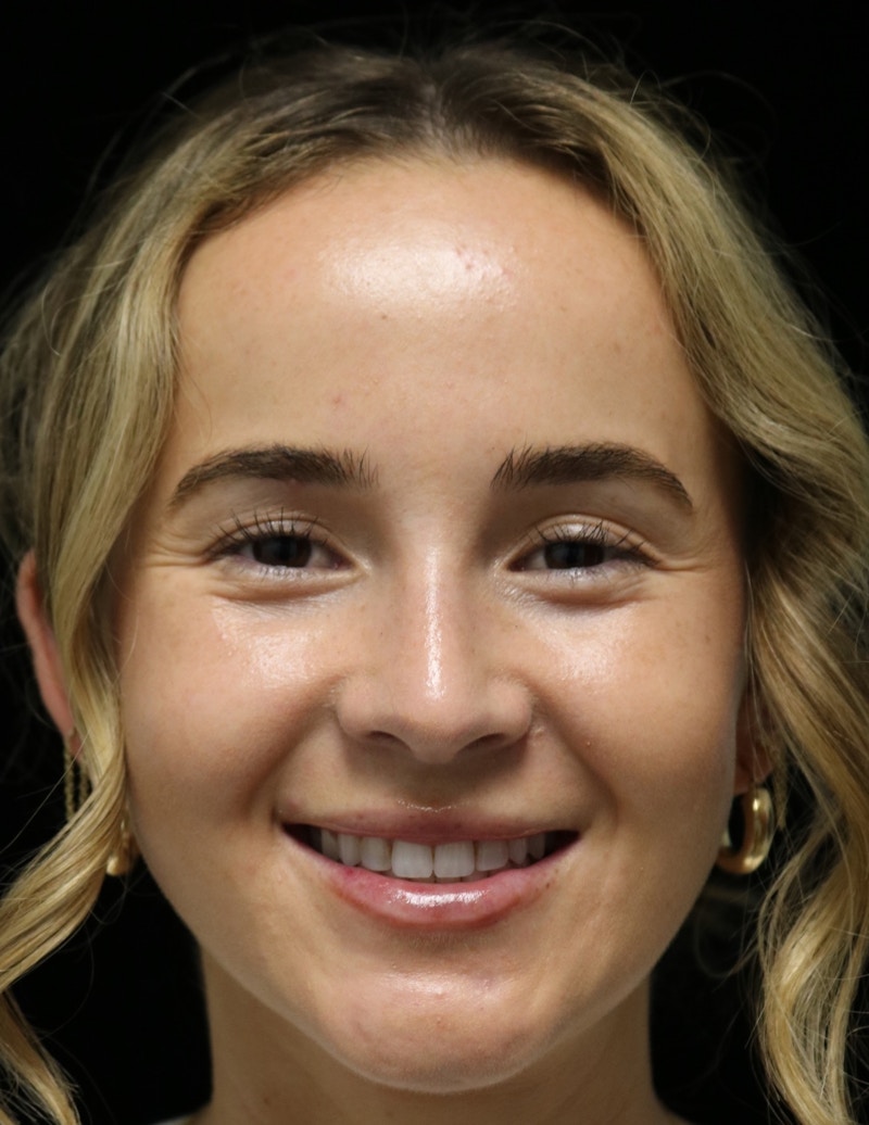 Beverly Hills Rhinoplasty Before & After Gallery - Patient 264675 - Image 8 Dr. Deepak Raj Dugar