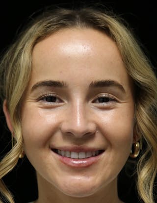 Beverly Hills Rhinoplasty Before & After Gallery - Patient 264675 - Image 8 Dr. Deepak Raj Dugar