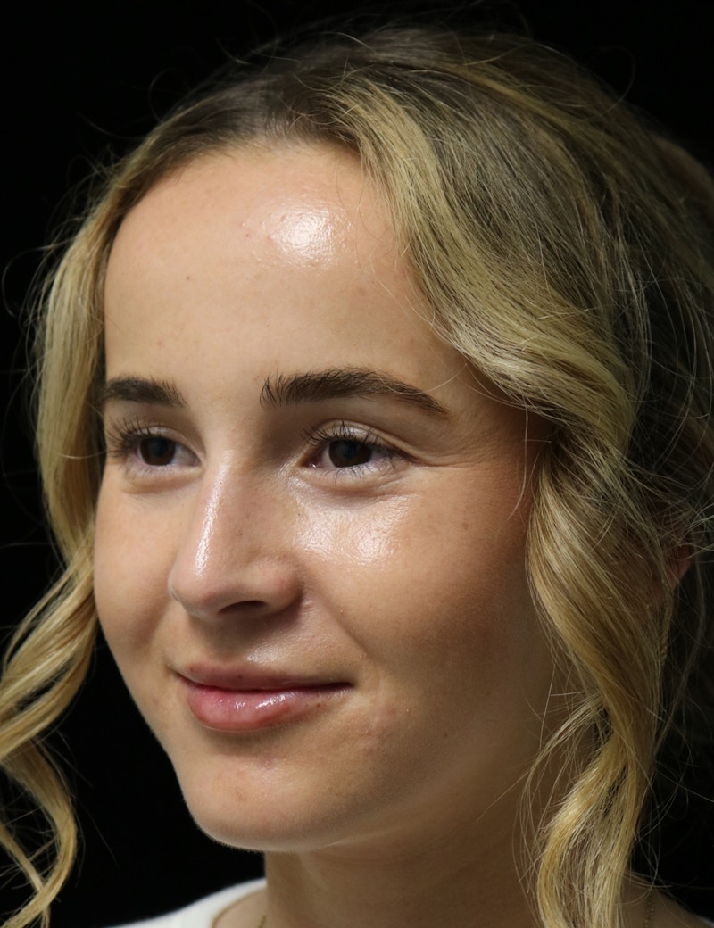 Beverly Hills Rhinoplasty Before & After Gallery - Patient 264675 - Image 10 Dr. Deepak Raj Dugar