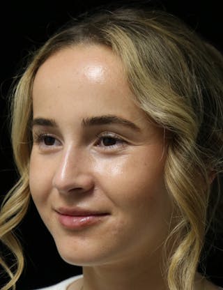 Beverly Hills Rhinoplasty Before & After Gallery - Patient 264675 - Image 10 Dr. Deepak Raj Dugar