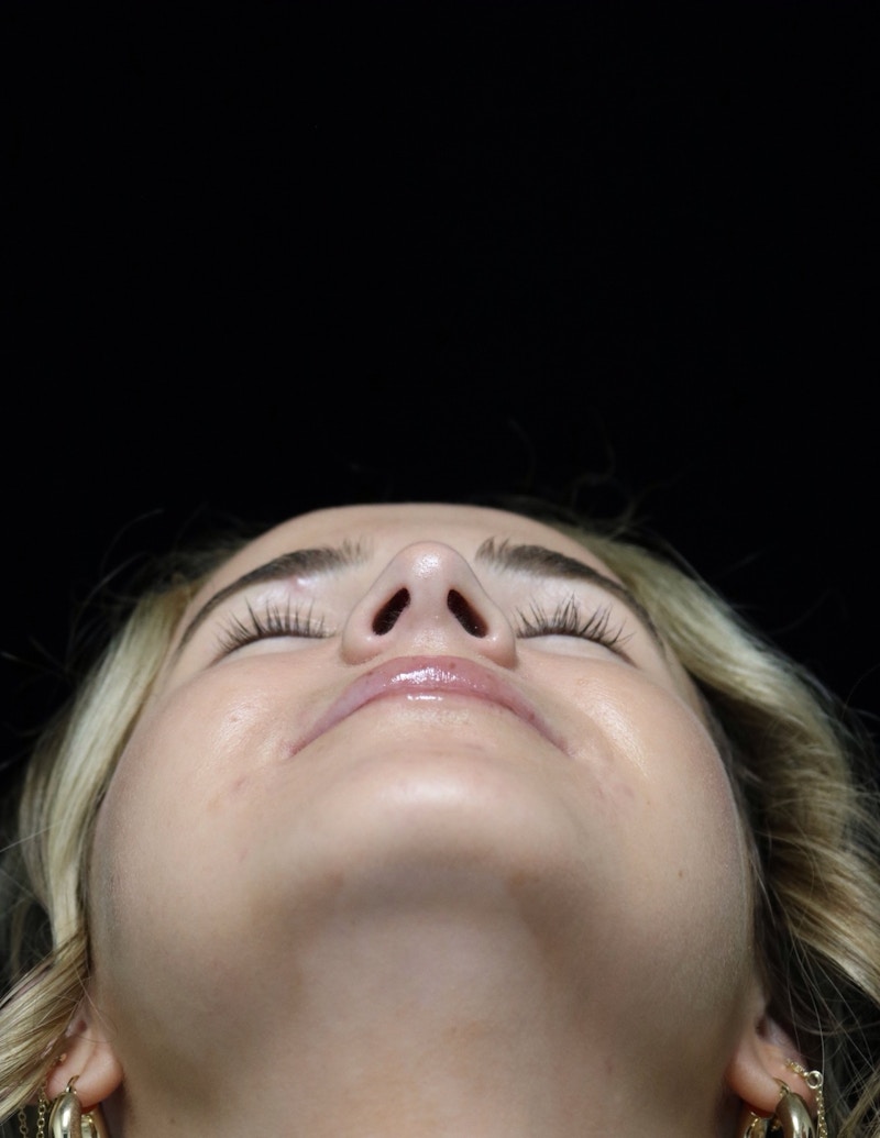 Beverly Hills Rhinoplasty Before & After Gallery - Patient 264675 - Image 14 Dr. Deepak Raj Dugar