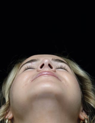 Beverly Hills Rhinoplasty Before & After Gallery - Patient 264675 - Image 14 Dr. Deepak Raj Dugar