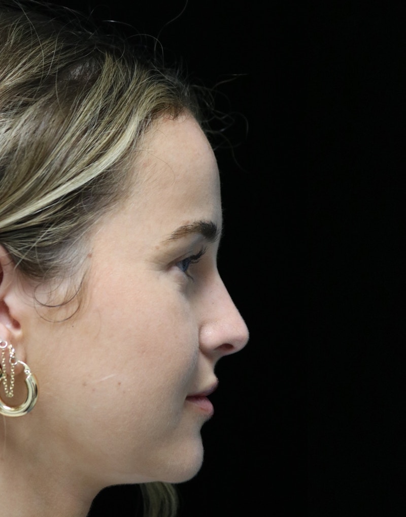 Beverly Hills Rhinoplasty Before & After Gallery - Patient 264675 - Image 2 Dr. Deepak Raj Dugar