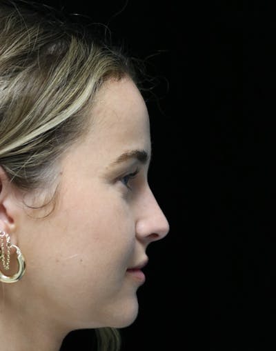 Beverly Hills Rhinoplasty Before & After Gallery - Patient 264675 - Image 2 Dr. Deepak Raj Dugar