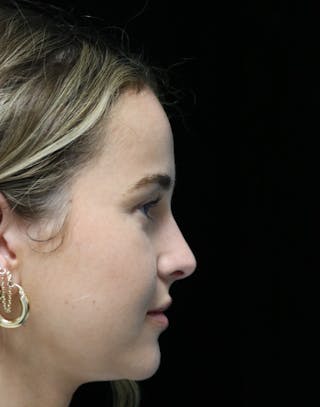 Beverly Hills Rhinoplasty Before & After Gallery - Patient 264675 - Image 2 Dr. Deepak Raj Dugar