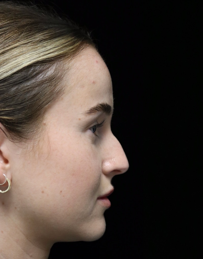 Beverly Hills Rhinoplasty Before & After Gallery - Patient 264675 - Image 1 Dr. Deepak Raj Dugar